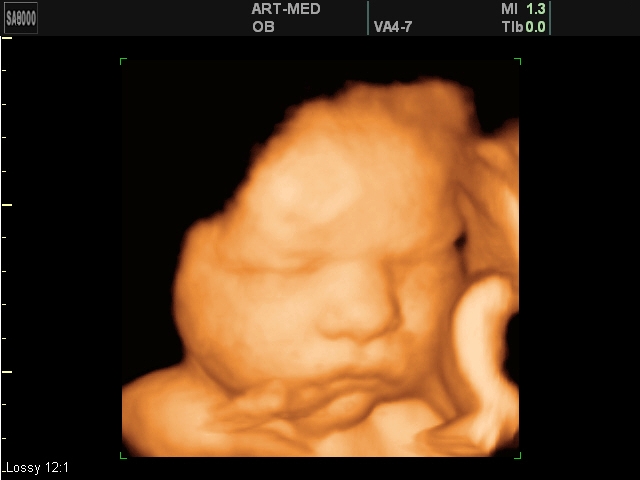 Трехмерное УЗИ плода - Клочкова Ирина, 39 недель и фото ребенка