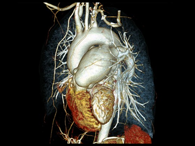 КТ ангиография сердца и сосудов грудной клетки
