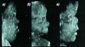 Изображения лица плода при паталогии: a) - синдром Дауна, б) - микрогнатия, в) - синдром Апера